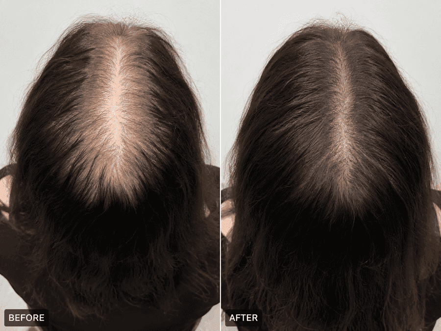 Before and after results for a female HairGain® patient showing fuller hair